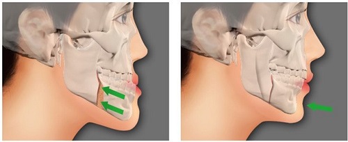 Phẫu thuật cắt xương hàm có nguy hiểm không? Nha khoa giải đáp 3 Phẫu thuật cắt xương hàm có nguy hiểm không? Nha khoa giải đáp 3