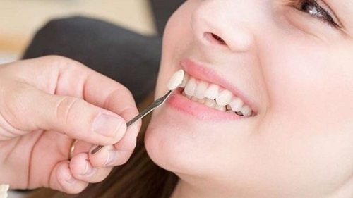 Trồng răng khểnh ở đâu uy tín và an toàn? 1 Trồng răng khểnh ở đâu uy tín và an toàn? 1