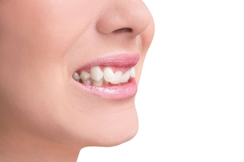 Trồng răng khểnh ở đâu uy tín và an toàn? 2 Trồng răng khểnh ở đâu uy tín và an toàn? 2