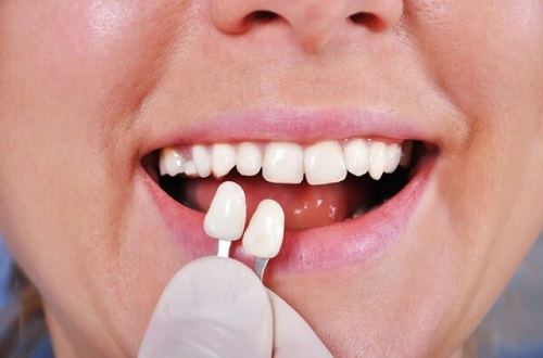 Trồng răng khểnh ở đâu uy tín và an toàn? 3 Trồng răng khểnh ở đâu uy tín và an toàn? 3