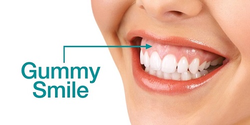 Cười hở lợi phải làm sao? Nguyên nhân dẫn đến tình trạng này 1 Cười hở lợi phải làm sao? Nguyên nhân dẫn đến tình trạng này 1