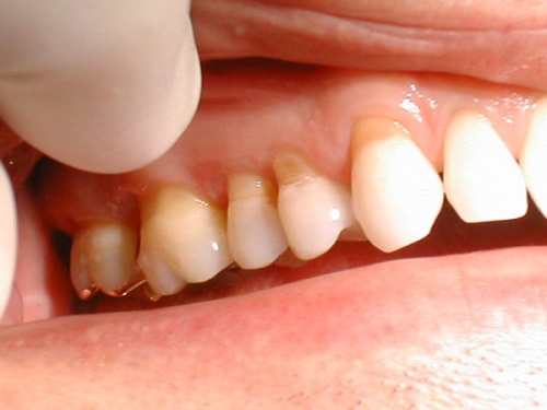 Cười hở lợi phải làm sao? Nguyên nhân dẫn đến tình trạng này 2 Cười hở lợi phải làm sao? Nguyên nhân dẫn đến tình trạng này 2