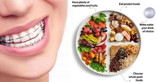 Niềng răng ăn uống như thế nào? Bạn đã biết chưa? 4 Niềng răng ăn uống như thế nào? Bạn đã biết chưa? 4