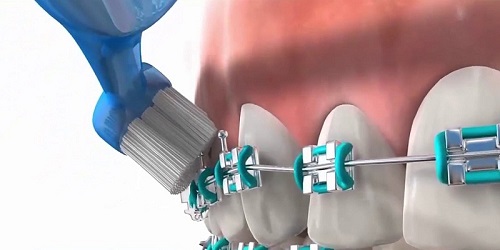 Niềng răng có hại cho sức khỏe không? Chuyên gia tư vấn 4 Niềng răng có hại cho sức khỏe không? Chuyên gia tư vấn 4