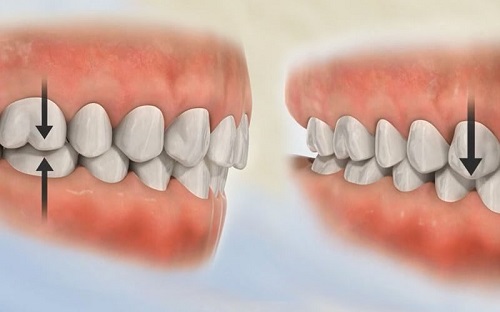 Niềng răng khớp cắn sâu - Tìm hiểu về khớp cắn sâu 1