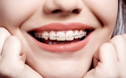 Niềng răng lộn xộn - Phục hình hiệu quả từ nha khoa 1