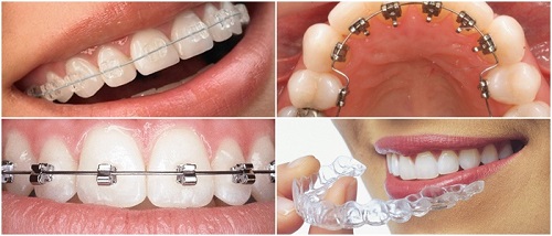 Niềng răng lộn xộn - Phục hình hiệu quả từ nha khoa 2