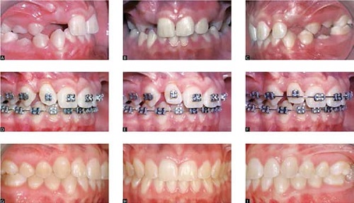 Niềng răng phải nhổ răng nào giúp đạt kết quả cao? 2