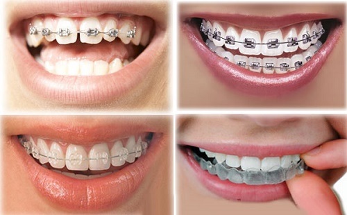 Niềng răng phải nhổ răng nào giúp đạt kết quả cao? 3