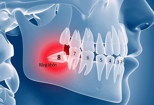 Răng khôn hàm trên mọc ngầm - Dấu hiệu nhận biết 2