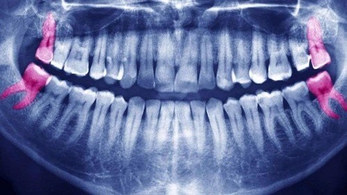 Răng khôn hàm trên mọc ngầm - Dấu hiệu nhận biết 3