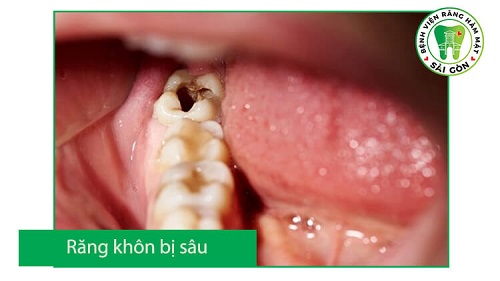 Răng khôn hàm trên bị sâu - Phương pháp xử lý 2