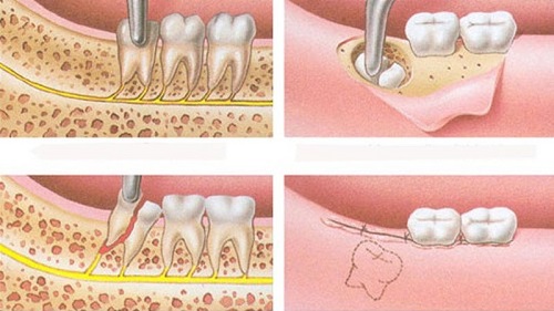 Răng khôn hàm trên bị sâu - Phương pháp xử lý 3