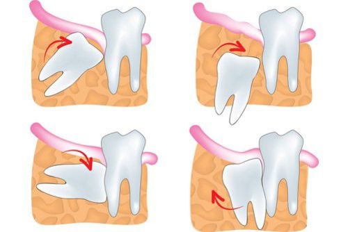 Răng khôn mọc ngược gây ra biến chứng gì? 3