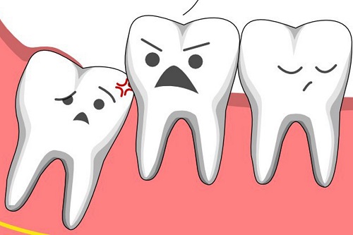 Đau răng khôn dẫn đến đau tai - Dấu hiệu mọc răng khôn 1