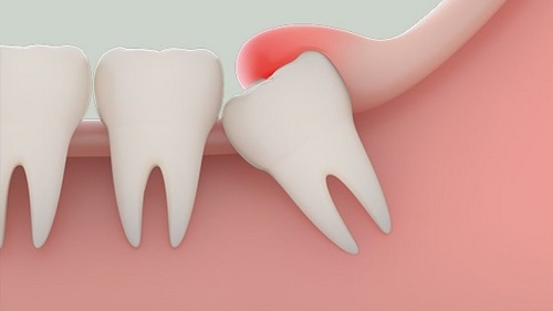Đau răng khôn dẫn đến đau tai - Dấu hiệu mọc răng khôn 2