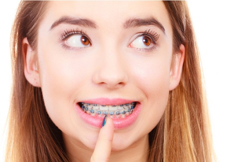 Niềng răng có bị hóp má không? Giải đáp thực hư tình trạng này 1
