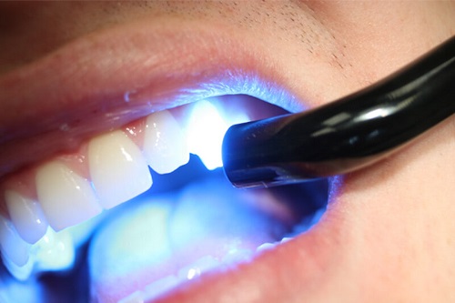 Trồng răng khểnh có đau không? Nên áp dụng kỹ thuật trồng nào? 3