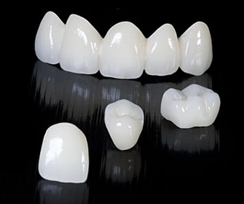 Răng sứ bị hỏng phải xử lý ra sao cho hiệu quả? 1