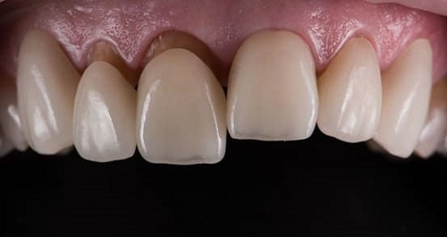 Răng sứ bị hỏng phải xử lý ra sao cho hiệu quả? 2