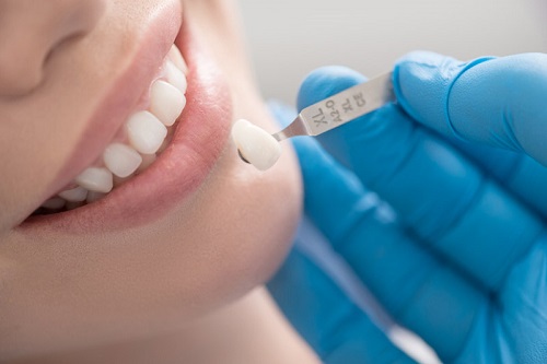 Răng sứ bị hỏng phải xử lý ra sao cho hiệu quả? 3