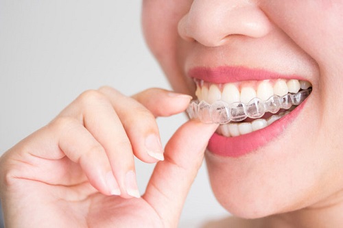Niềng răng invisalign có nhổ răng không? Nha khoa tư vấn 3