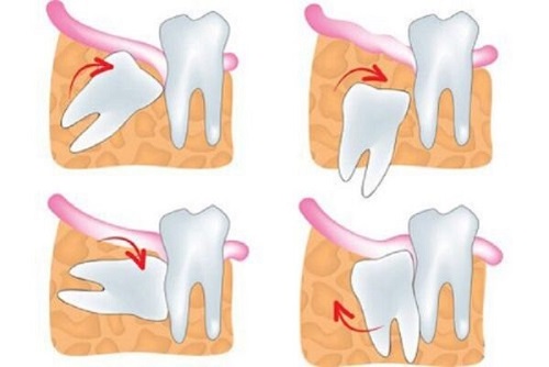 Răng khôn không đau có nên nhổ? Giải đáp thắc mắc 3