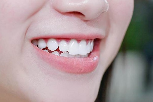Răng sứ bị hở - Cách xử lý đảm bảo an toàn 2