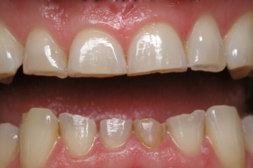 Răng sứ bị mòn - Nguyên nhân do đâu gây ra? 1
