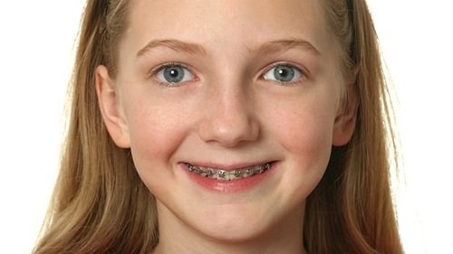Niềng răng cho trẻ 10 tuổi cần nắm bắt thông tin gì? 1