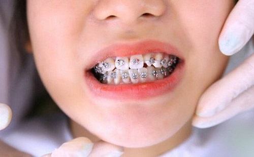 Niềng răng cho trẻ 10 tuổi cần nắm bắt thông tin gì? 2
