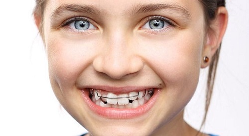 Niềng răng cho trẻ 10 tuổi cần nắm bắt thông tin gì? 3
