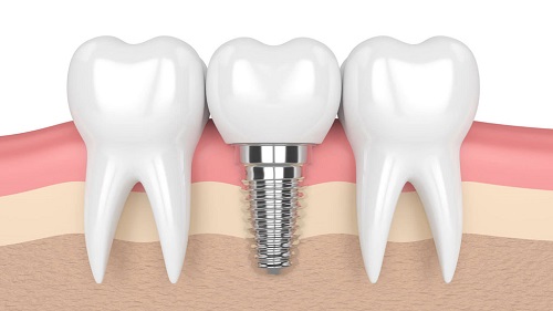 Trồng răng có chân răng được thực hiện ra sao? 3