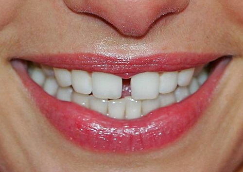 Răng sứ bị thưa khắc phục như thế nào? 2