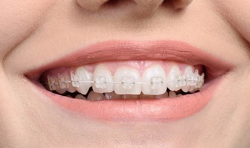 Niềng răng ăn cháo bao lâu để đảm bảo hiệu quả thực hiện? 1