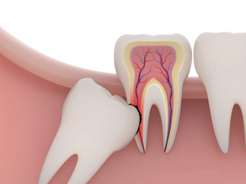 Răng khôn bị sâu chảy máu - Cách chữa trị dứt điểm 1