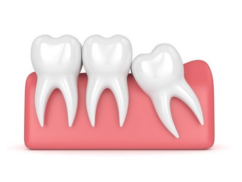Răng khôn bị sâu chảy máu - Cách chữa trị dứt điểm 2