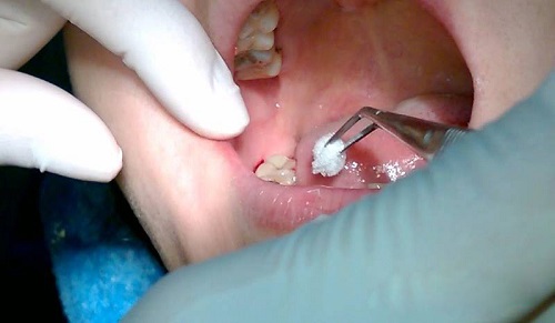 Răng khôn bị nhiễm trùng là do đâu? 3