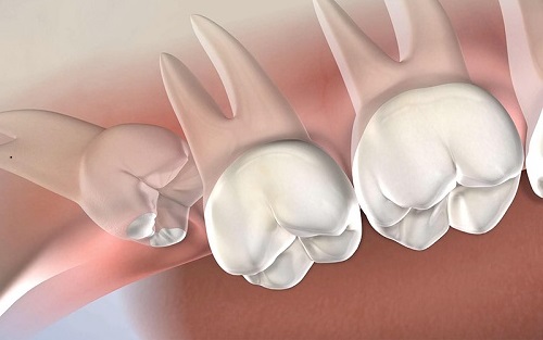 Răng khôn làm đau hàm nên làm gì? 1