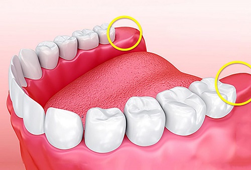 Răng khôn có phải răng số 8 không? Thông tin từ nha khoa 1