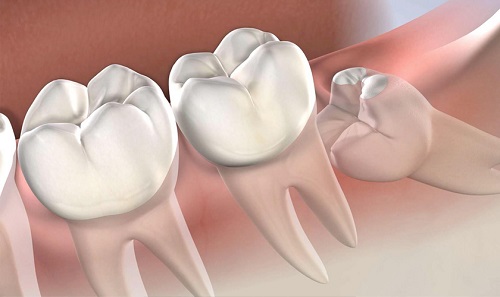 Răng khôn làm lệch mặt có thể gây biến chứng gì? 1