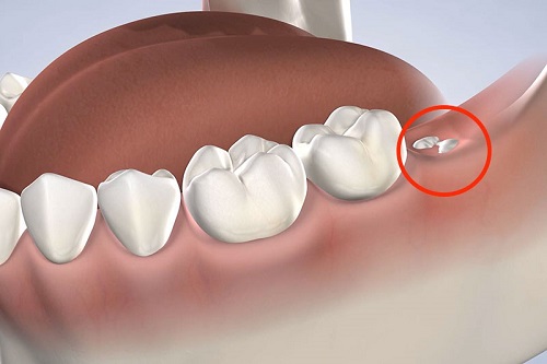 Răng khôn có bắt buộc phải nhổ không bác sĩ? 2