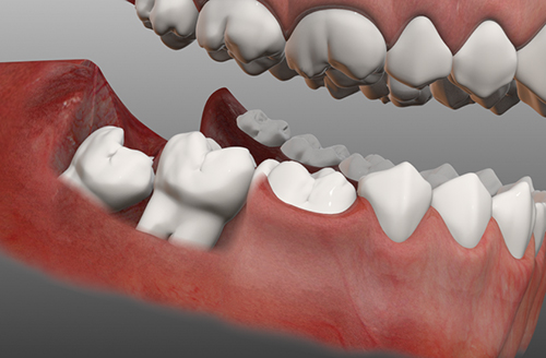 Răng khôn có bắt buộc phải nhổ không bác sĩ? 3