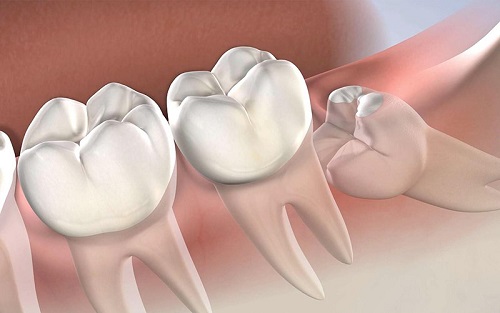 Răng khôn dị dạng có gây ra biến chứng không? 2