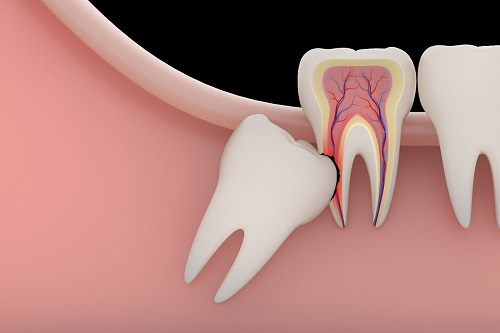 Răng khôn dị dạng có gây ra biến chứng không? 3