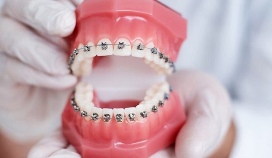Niềng răng lúc nào đau nhất? Bí quyết giảm đau hiệu quả 2